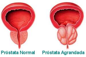 Alimentación y los riesgos de Problemas de Próstata